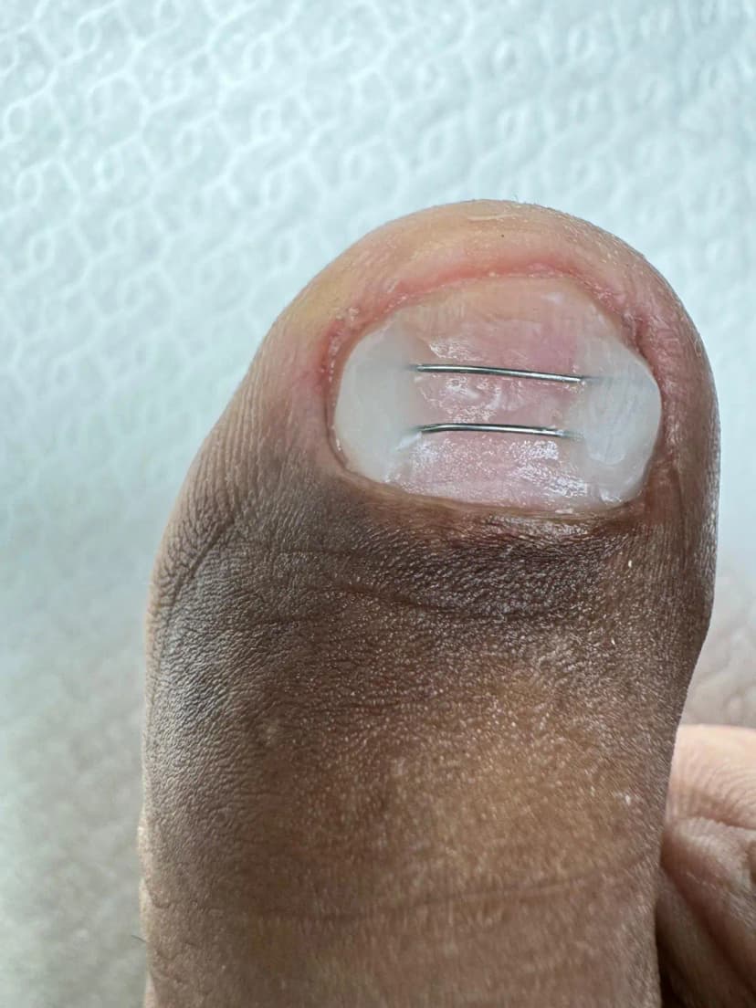 אחרי - גשר אקריל